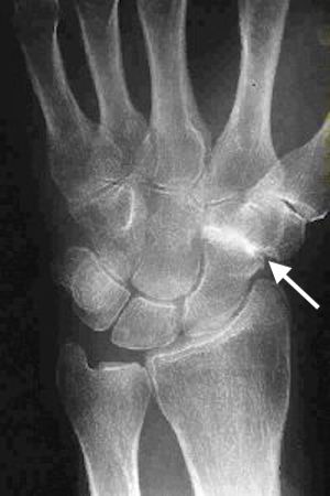 osteoarthritis-scaphotrapezial-trapezoid-stt-joint-hand-surgery